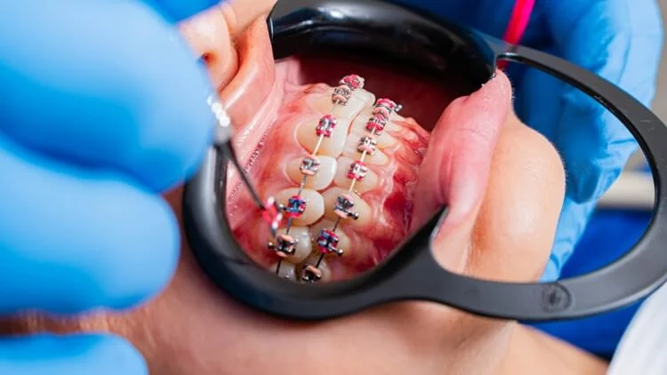 Tipos de Brackets y Ortodoncia